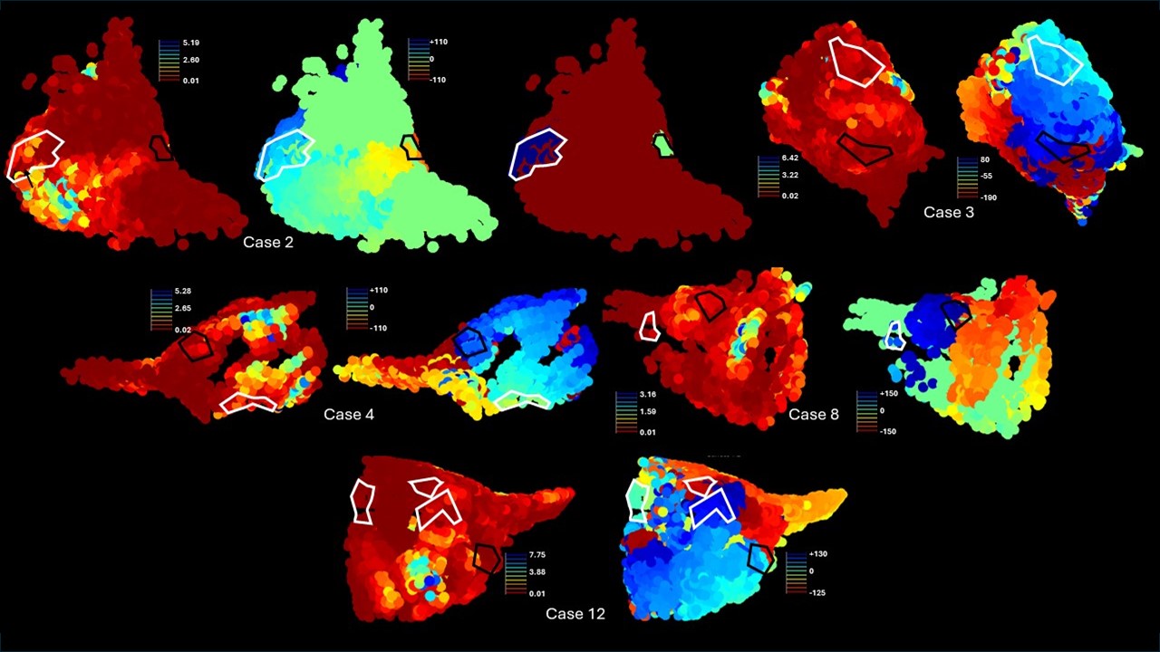 Selected patient voltage and activation maps for macroreentrant atrial tachycardia with predicted and actual ablation targets outlined